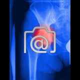 5.09_huefte.coxarthrose-0002.ap-s