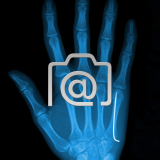 4.01_hand.mittehandbruch.d5-koepfchen.mit.k-draht-0001.ap