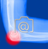 1.02_ellbogen.epicondylitis-0001.lat-s