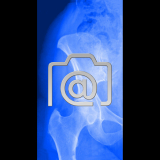 5.04_huefte.bursitis.trochanterica-0002.ap