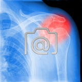 7.02_schulter.impingement.subacromial-0001.ap-s
