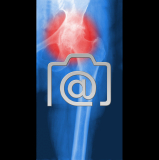 5.07_huefte.coxarthrose-0001.ap-s