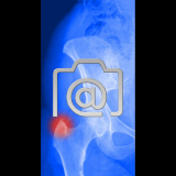 5.05_huefte.bursitis.trochanterica-0002.ap-s