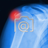 7.05_schulter.tendinitis.calcarea-0001.ap-s