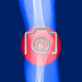 1.04_ellbogen.epicondylitis-0002.ap-s