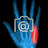 4.02_hand.mittehandbruch.d5-koepfchen.mit.k-draht-0001.ap-s