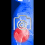 5.03_huefte.bursitis.trochanterica.coxalgie-0001.ap-s