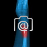 8.02_unterarm.radiusbruch.mit.k-draht-0001.lat-s