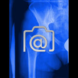 5.08_huefte.coxarthrose-0002.ap