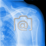 7.01_schulter.impingement.subacromial-0001.ap