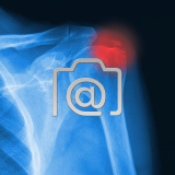 7.07_schulter.tendinitis.calcarea-0002.ap-s