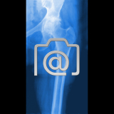 5.06_huefte.coxarthrose-0001.ap