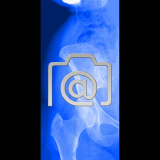 5.02_huefte.bursitis.trochanterica.coxalgie-0001.ap