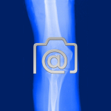 1.03_ellbogen.epicondylitis-0002.ap